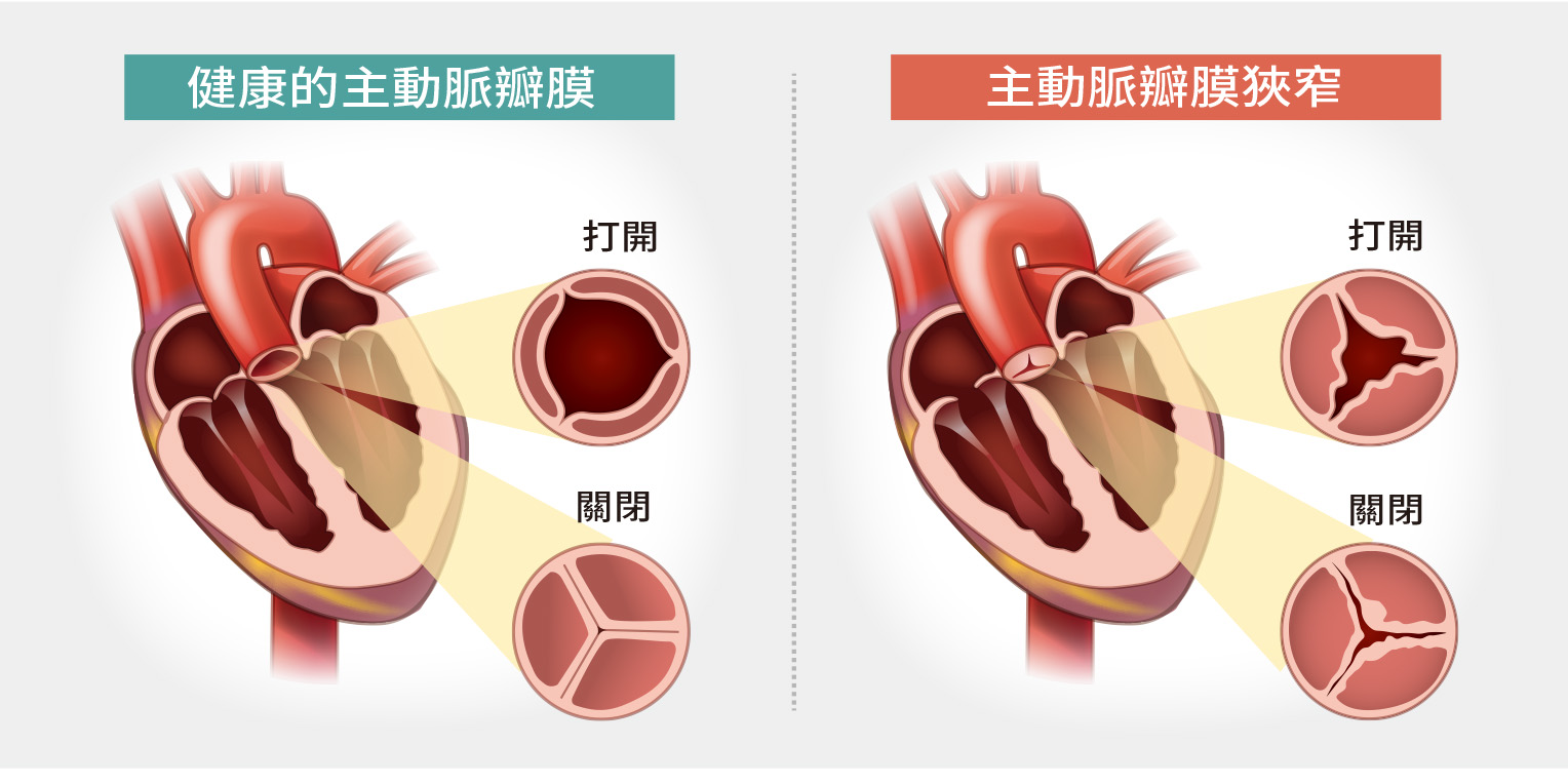 主動脈狹窄為較常見的先天性動脈血管畸形，臨床上易被忽略。