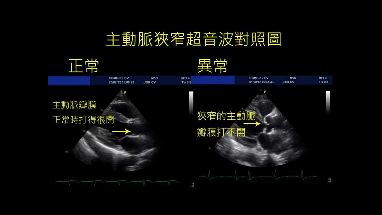 主動脈狹窄為較常見的先天性動脈血管畸形，臨床上易被忽略。