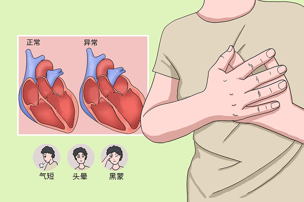 心肌梗塞的年齡、性別、急救、預兆、預防等內容一次說清