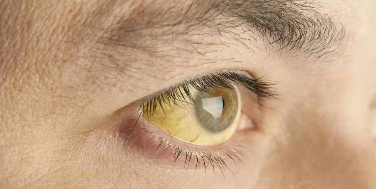 眼睛如若出現三個異常狀況，可能體內有癌症。