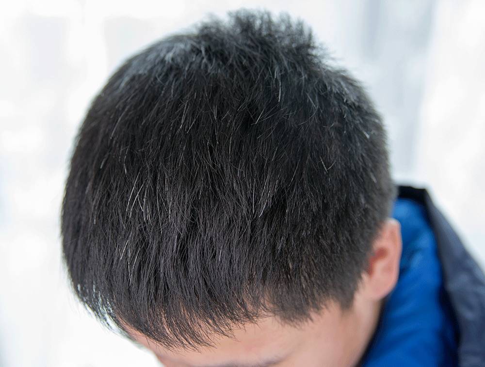 年輕人長白髮的原因和處理方式。